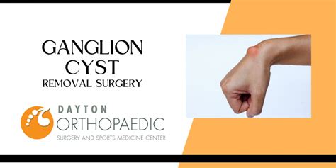 Ganglion Cyst Removal Dayton Orthopaedic Surgery