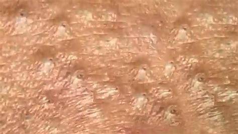 Deep Blackhead Extraction Cystic Acne And Pimple Popping 53 Youtube