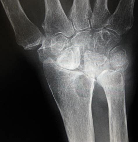 Arthritis Of The Wrist Orthoinfo Aaos