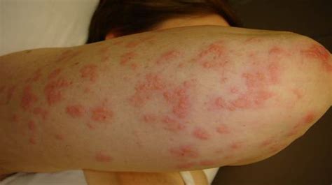 Dermatis Herpetiformis Causes Symptoms Complications