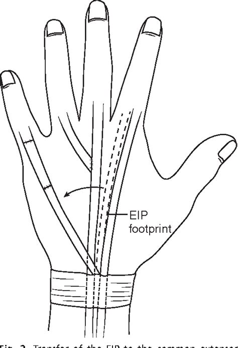 Figure 2 From Tendon Transfers In The Rheumatoid Hand For