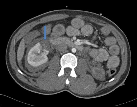 Right Renal Parenchymal Laceration Arrow With Perinephric Hematoma