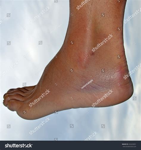 Swelling And Bruising Caused By A Sprained Ankle Stock Photo 222223051