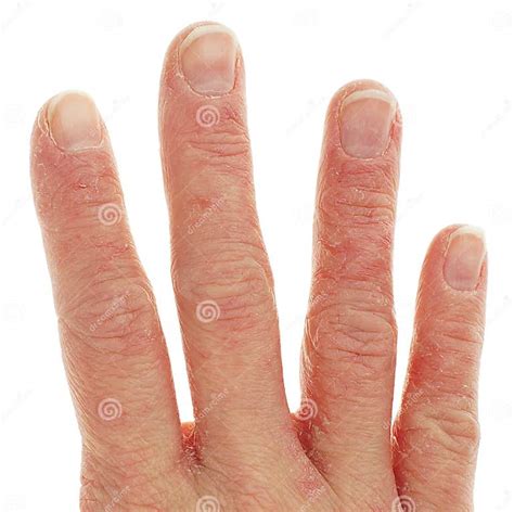 Closeup Of Eczema Dermatitis On Fingers Stock Image Image Of Health