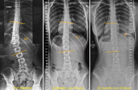 Scoliosis Before And After