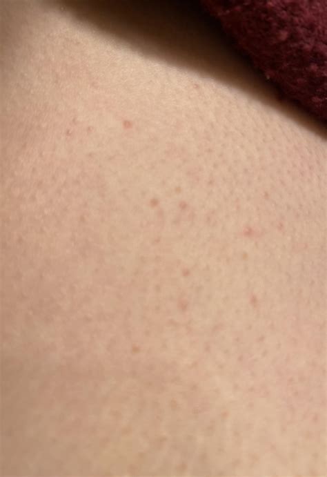 Small Bumps On Chest Fungal Acne Kp Racne