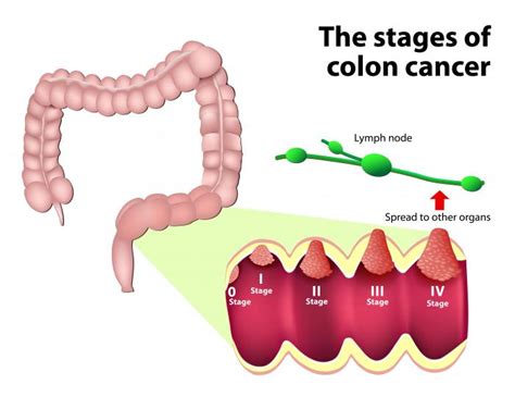 Colon Cancer Causes Symptoms And Treatments