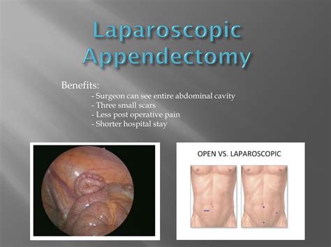 PPT The Open Versus Closed Appendectomy PowerPoint Presentation
