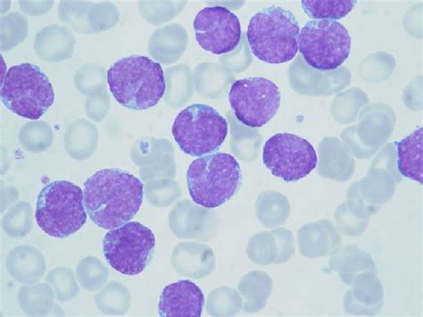Peripheral Blood Smear A Population Of Mantle Cells With Cleaved