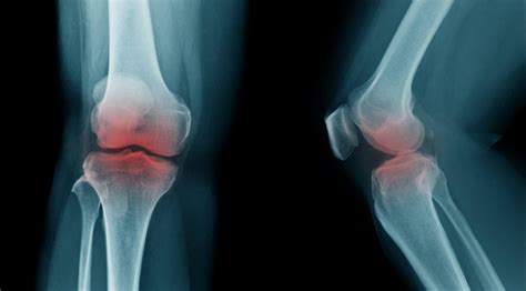 Osteoarthritis Symptoms Complications And Treatment