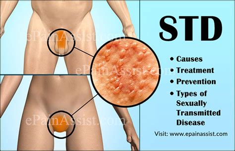Std Causes Symptoms Treatment Prevention Types Of