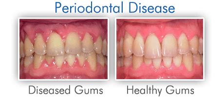 Periodontics Periodontal Gum Disease Hudson Dental Center
