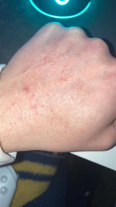Anyone Else Get A Rash Or Dry Skin On Their Hands During Accutane