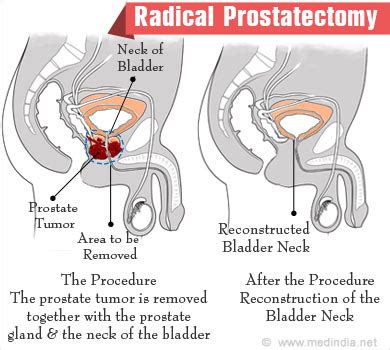 Radical Prostatectomy Procedure