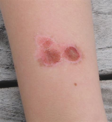 List 91 Pictures Pictures Of Skin Rashes On Arms Completed