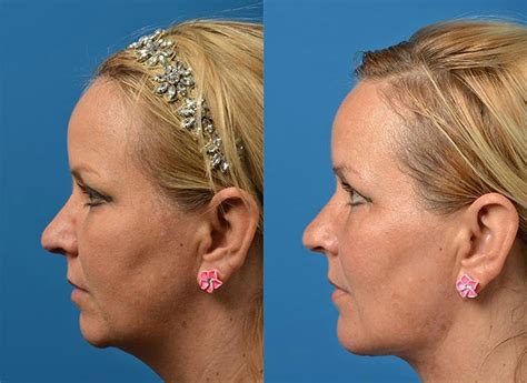Patient 122406521 Laser Assisted Weekend Neck Lift Before And After