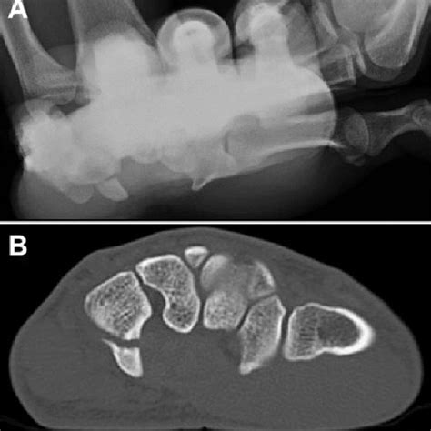 Follow Up Imaging Of Hamate With Hamate Hook Fracture On A Radiograph