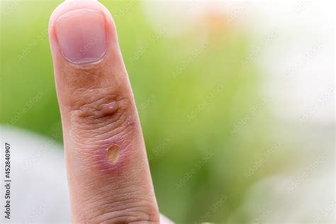 Paronychia Swollen Finger Inflammation Due To Bacterial Infection On A