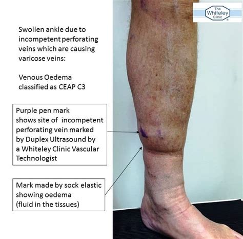 Swollen Ankle From Incompetent Perforator Veins The Whiteley Clinic