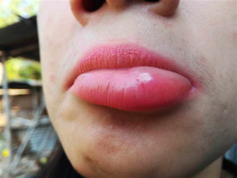 Swollen Bottom Lip Causes For No Reason Treatment Of Lower Lips Swelling American Celiac