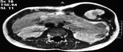 Anterior Abdominal Wall Synovial Sarcoma A Rare Presentatio