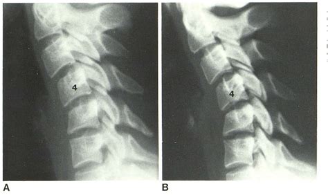 Pdf Anterior Subluxation Of The Cervical Spine Hyperflexion Sprain My