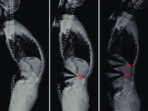 Two Level Pedicle Subtraction Osteotomy Is Performed When Single Level