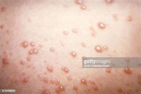 Herpesviridae Chickenpox Caused Pustulovesicular Rash On The Skin Due