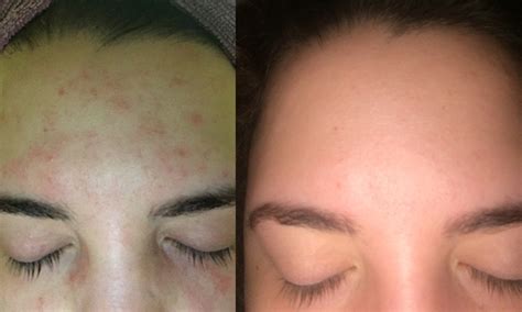 Allergy Spots On Face How To Get Rid Of Red Spots On Face Causes