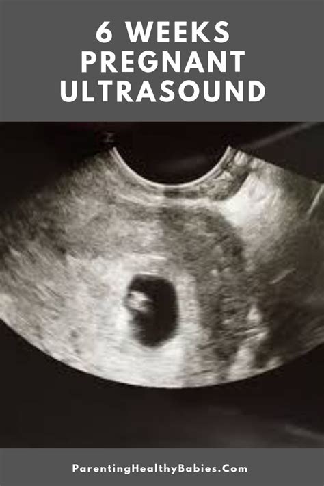 Ultrasound At 6 Weeks All You Need To Know Pregnancy Ultrasound 6 Weeks Pregnant Ultrasound
