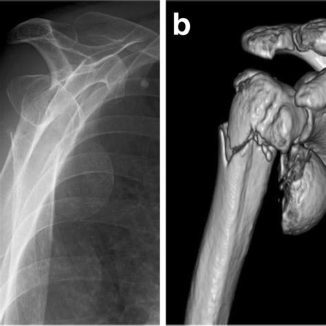Left Proximal Humeral Fracture Of A 53 Year Old Man The Humeral Head