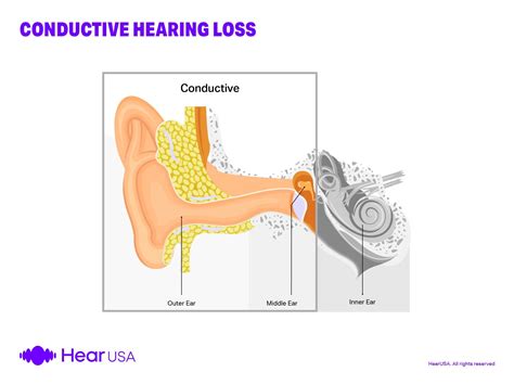 Conductive Hearing Loss The Complete Guide 2023