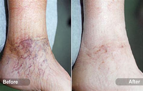 Laser Spider Vein Treatment 50 Off Sclerotherapy