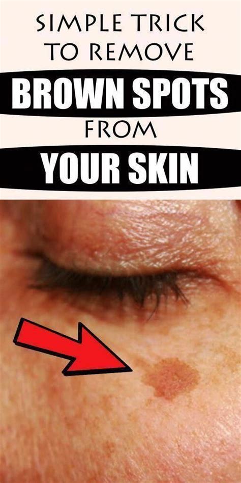 Pin On Sun Damage On Face Brown Spots