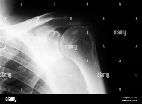 La tendinitis de calcificación Radiografía del hombro de un paciente con tendinitis de