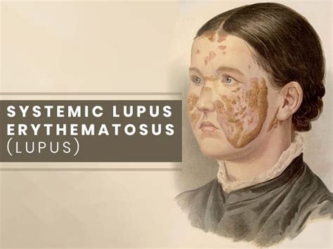 Systemic Lupus Erythematosus Causes Symptoms Complications