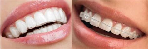 Types Of Orthodontic Treatment Archivos