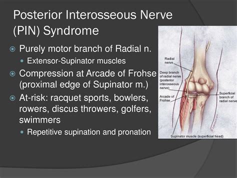 Posterior Interosseous Nerve Syndrome