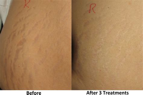Scar And Stretch Mark Treatments Rhett Women S Centerrhett Women S