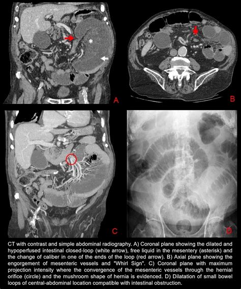 Closed Loop Intestinal Obstruction By Internal Hernia Serau Sociedad