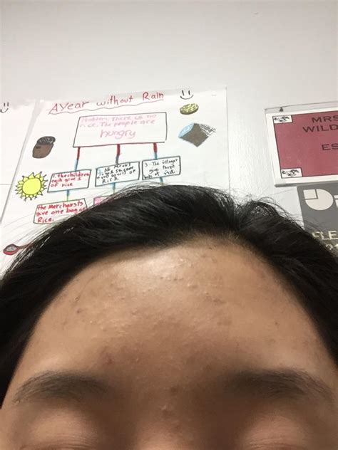 Small Colorless Bumps On Forehead And Hairline General Acne