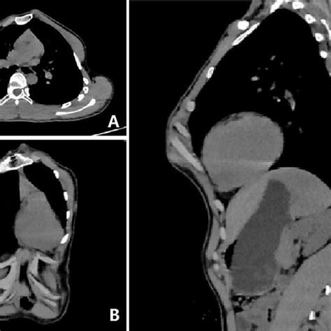 3d Reconstruction Images Of Thorax After Operation Download