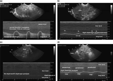 Monitoring Recovery From Diaphragm Paralysis With Ultrasound Chest My