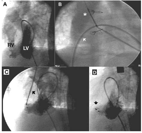 Percutaneous Closure Of Ventricular Septal Defect With An Amplatzer