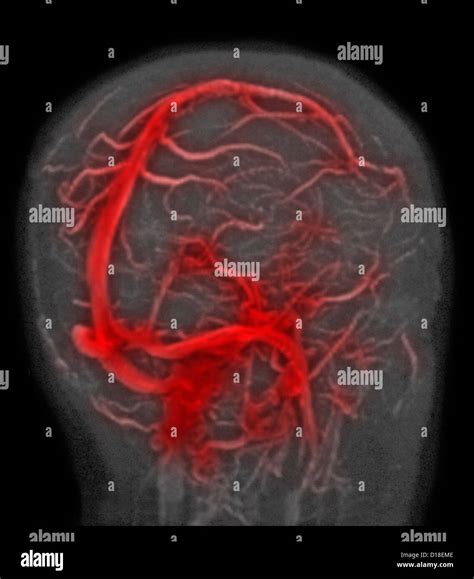 Normal Brain Mri Magnetic Resonance Venography Stock Photo Alamy