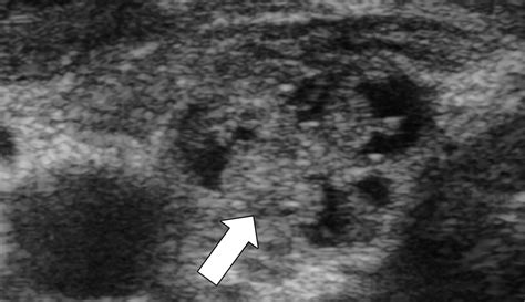 Incidental Thyroid Nodules Detected On Thoracic Contrast Enhanced Ct In