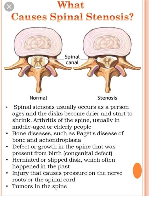 Can Spinal Stenosis Be Caused By A Herniated Disc Quora My XXX Hot Girl