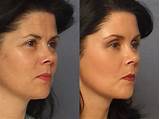 Pictures of Recovery Time Co2 Laser Skin Resurfacing