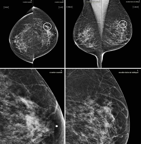 New Artificial Intelligence Tool Improves Breast Cancer Detection On