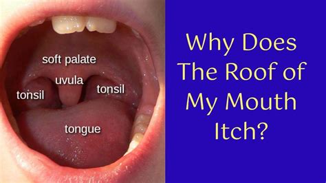 5 Reasons Why Does The Roof Of My Mouth Itch 2024